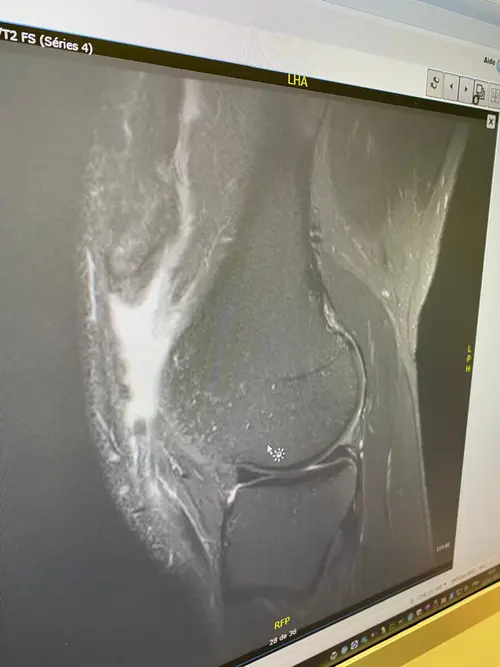Injury MRI